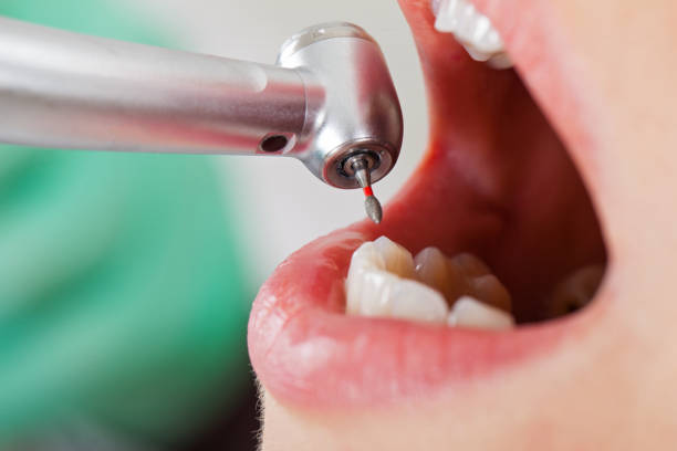 Best Emergency Wisdom Teeth Removal in Delhi, LA
